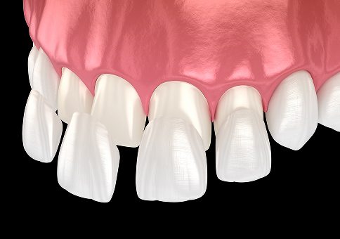 Zirconia Veneers