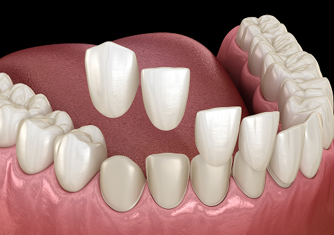 Composite Ceramic Veneers