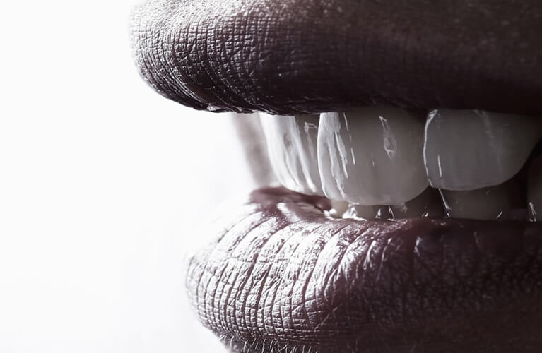 dental veneers banner